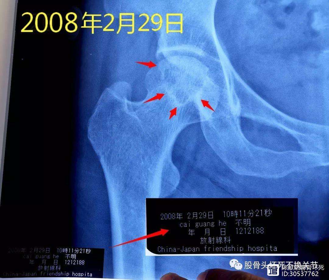 六盘水人工骨头医保报销多少(人工骨头医保报销多少比例)